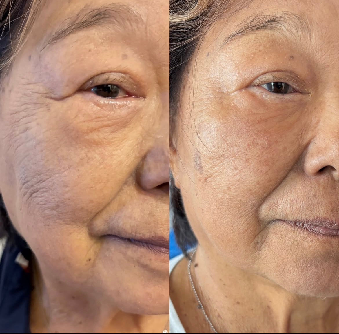 Baby Collagen Method™ — trabaja tu densidad dérmica