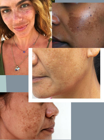 Manchas De Raíz: Protocolo para Melasma y Hiperpigmentación