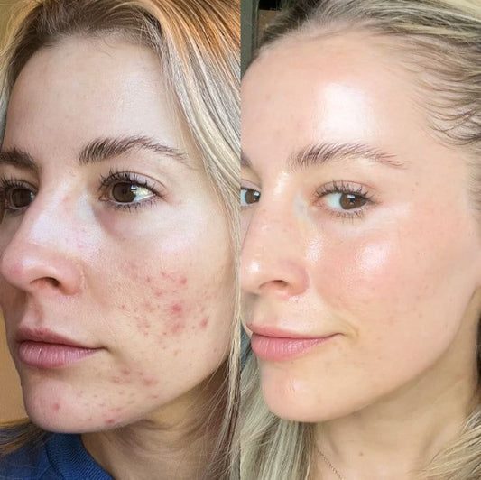 CLEAR SKIN CODE — Tu shortcut natural a una piel sin acné